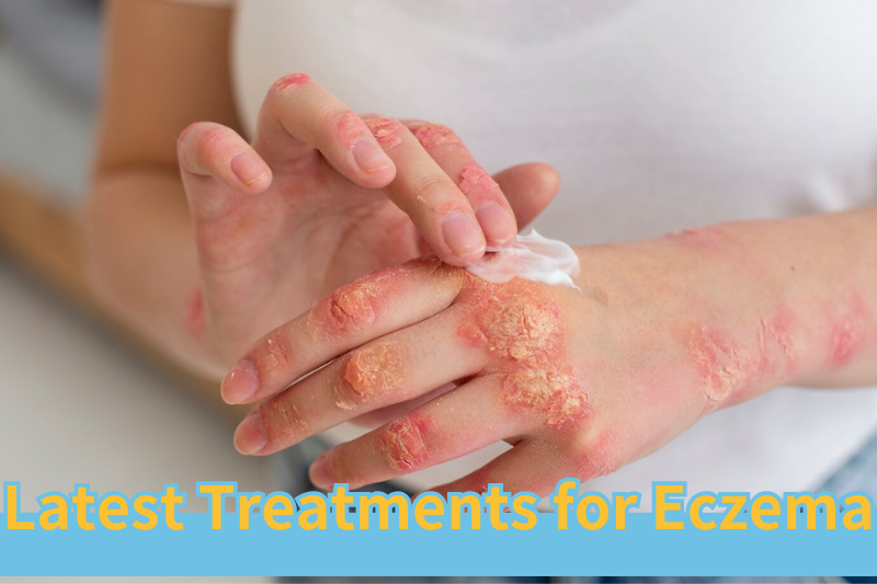 Can this be used to treat eczema without steroids?