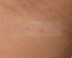 skin-problem-珍珠疣-img-46-2x